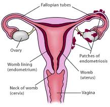 Endometriosis illustration
