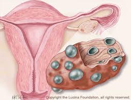 Polycystic Ovary Picture