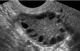 Ultrasound of Polycystic Ovary