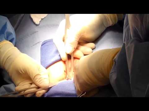 tubal surgery