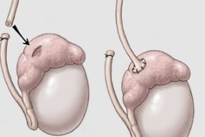 Vasectomy Reversal | NCCRM