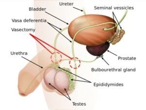 Vasectomy Reversal at NCCRM